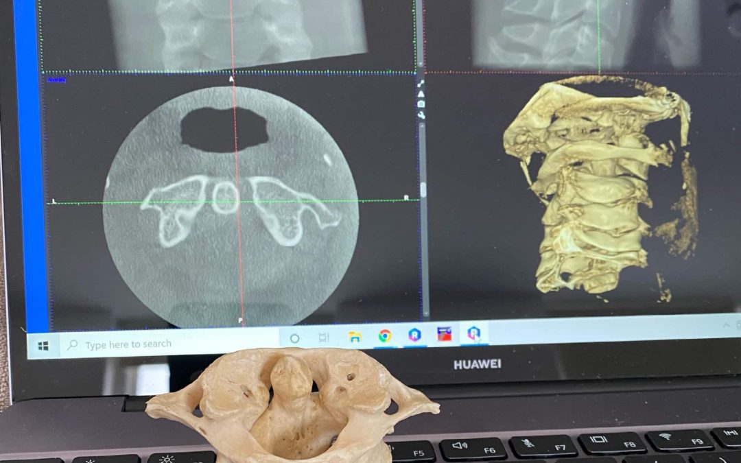 Consequences to Upper Cervical Malformations and Misalignments